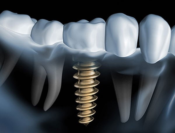 در مورد ایمپلنت دندان
