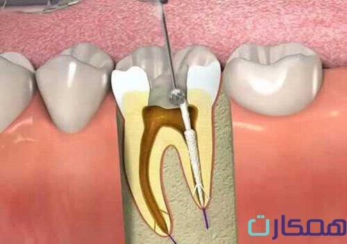 تخفیف عصب کشی دندان